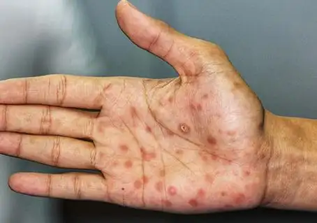 梅毒初期症状是皮肤或粘膜上形成硬下疳.