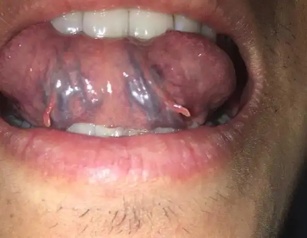 很着急这是口腔尖锐湿疣吗,还有些小的尖状突起,谢谢了.