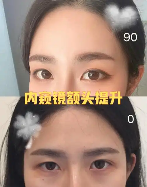 改善眉眼距离窄,眼睛小的额头提升术