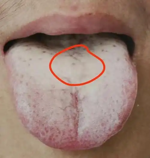 舌象:舌色淡白,舌尖红点,舌苔白厚腻润中医辩证为寒湿中阻