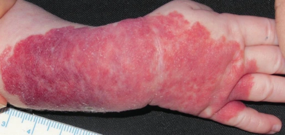 神奇的心得安——妙治血管瘤