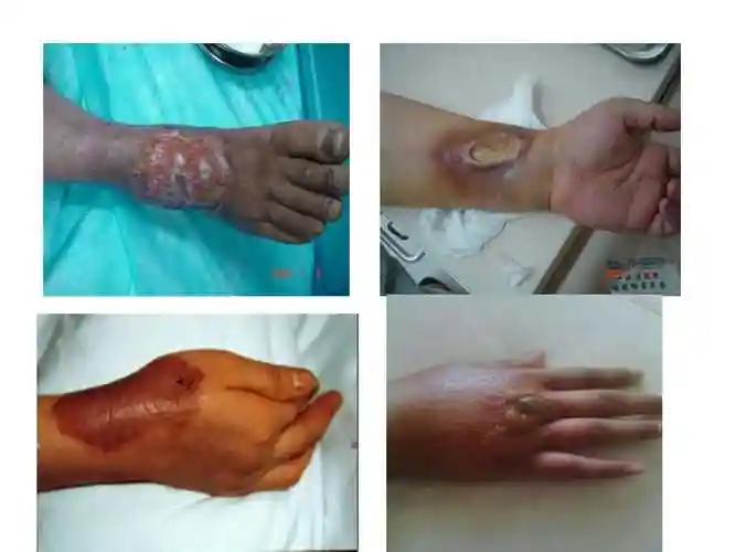 化疗药物外渗的护理1ppt