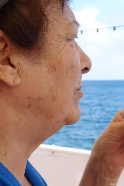 老年斑可以用激光去除吗?激光祛斑优点和缺点