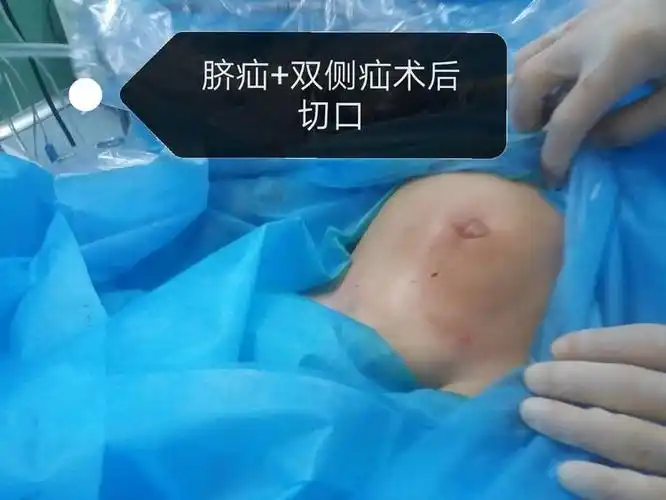 告别疝气,安心过年.