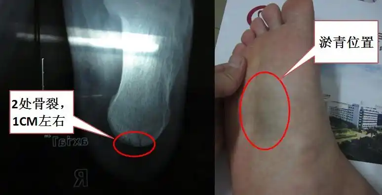 脚后跟骨裂骨折相关问题.请知道的朋友,帮忙解答.谢谢了!