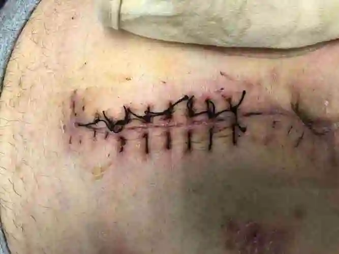 伤口缝合和术后伤口护理都很重要