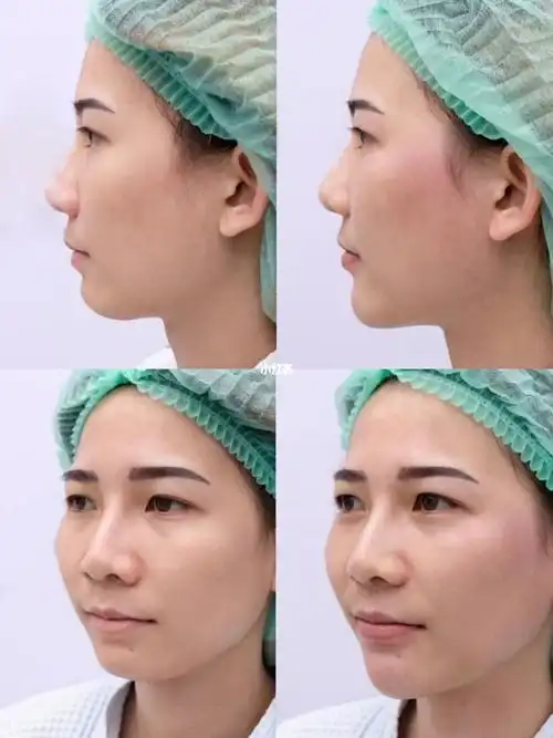 玻尿酸填充下巴