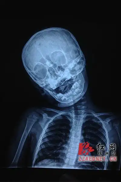 男童寰枢关节半脱位的影像.