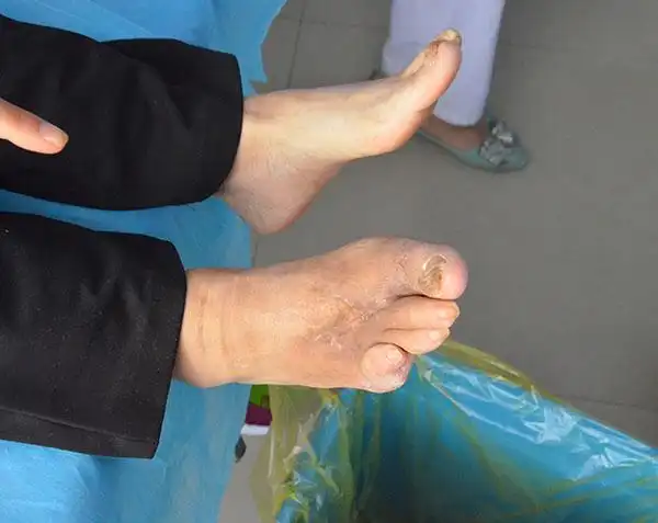 糖尿病患者与脚变形畸形