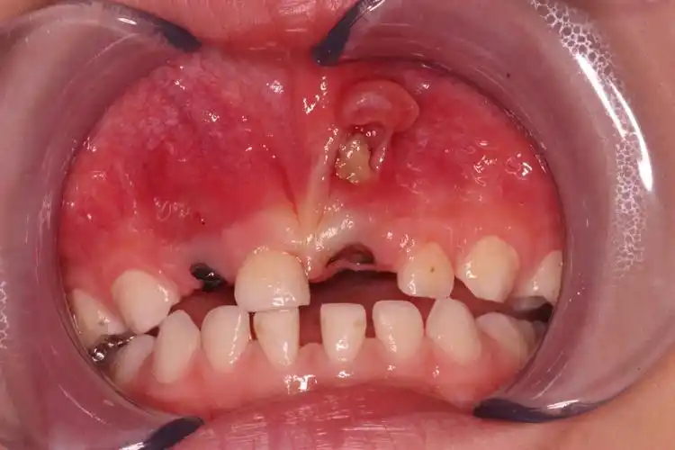 乳牙早晚都是要换的,只要不疼,乳牙龋齿不治也行吧?