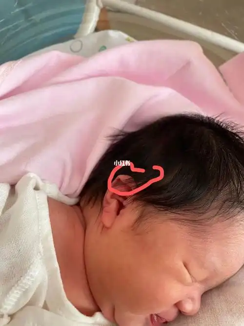 妹妹出生以后,当天下午儿科医生查房就发现了两只耳朵,都有垂耳的症状