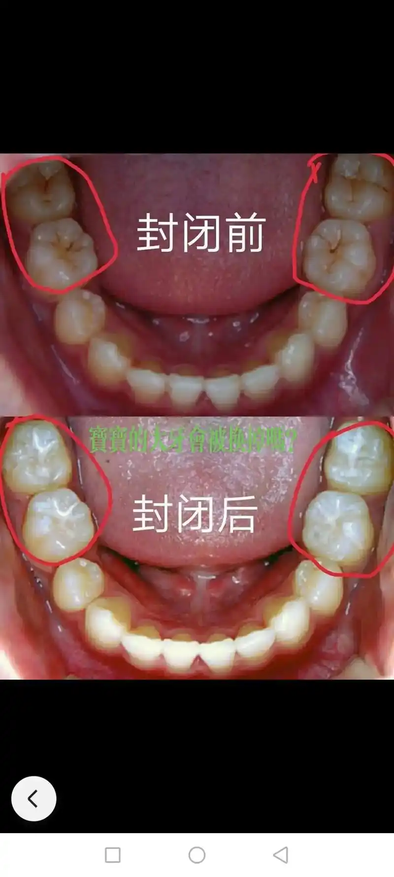 科普一下,小孩乳牙会被换掉,但是6岁以后新长的牙齿是不会被换 - 抖音