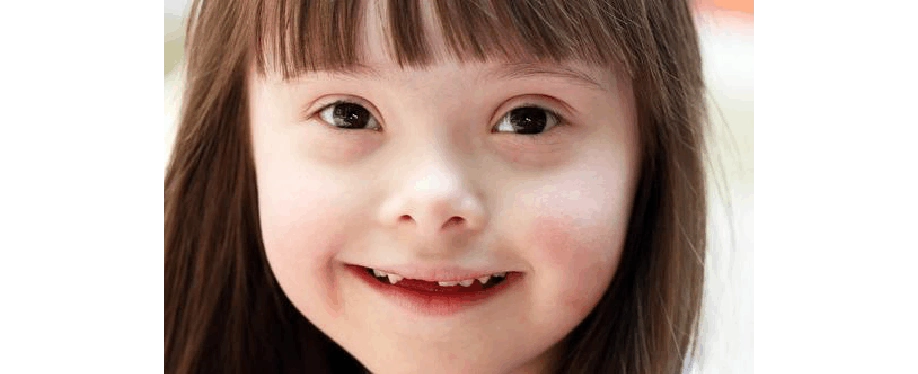 你了解唐氏症吗? 唐氏症有哪些症状?