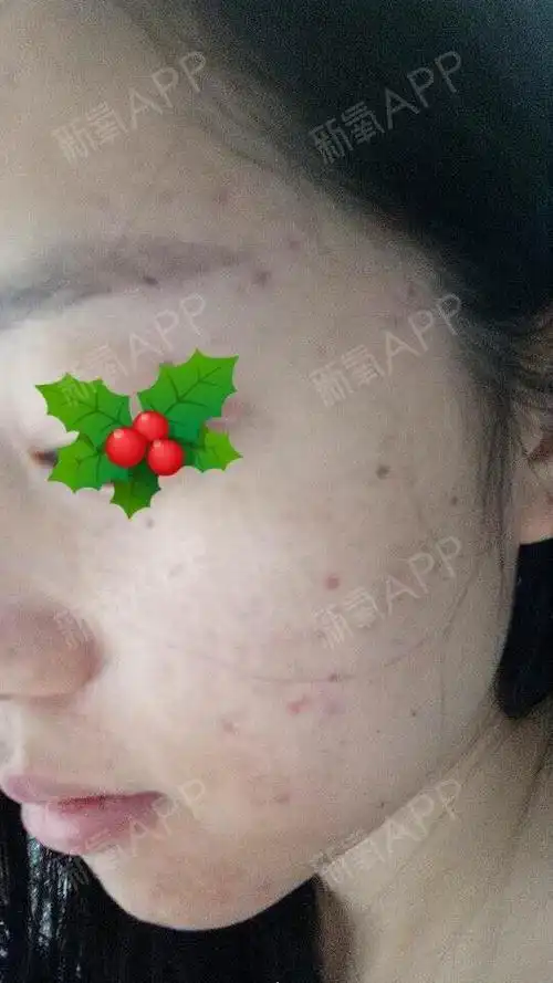 光子嫩肤opt(m22)第九天,痂已经脱得差不多了_圈子-新氧美容整形