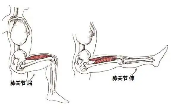 膝盖超伸是怎么回事