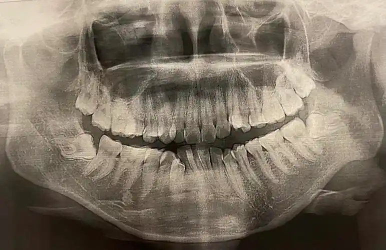 普通牙片暗藏玄机拔智齿四个小时