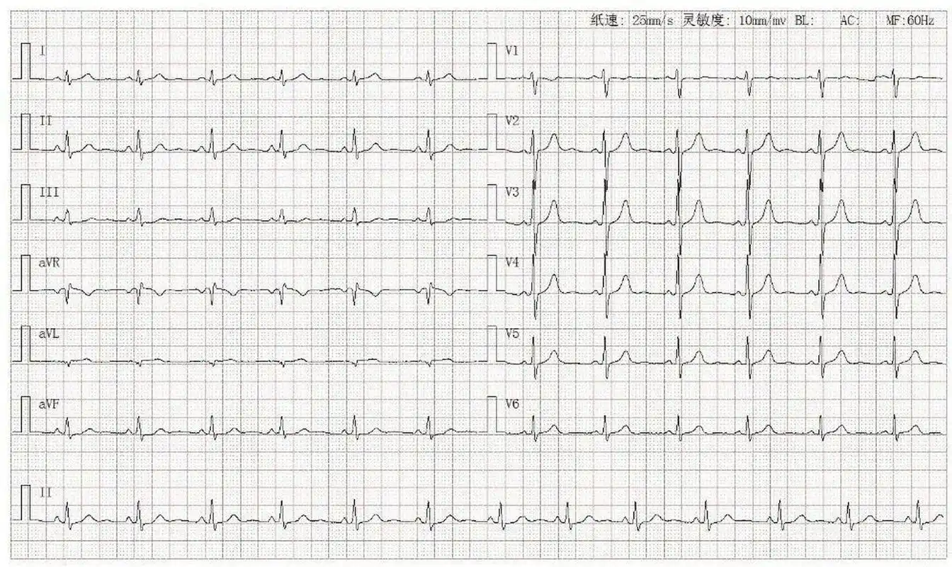 心电图学习|正常心电图 4.