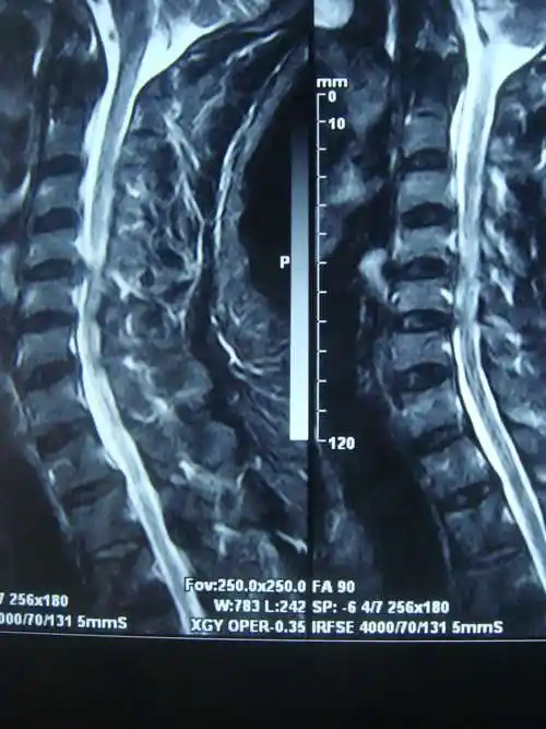 颈椎病(脊髓型) - 好大夫在线