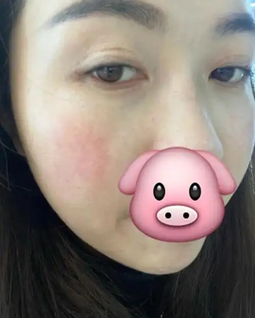 眼角纹都淡化了好多,认识我的人都知道天生角质层角质层薄破裂干裂