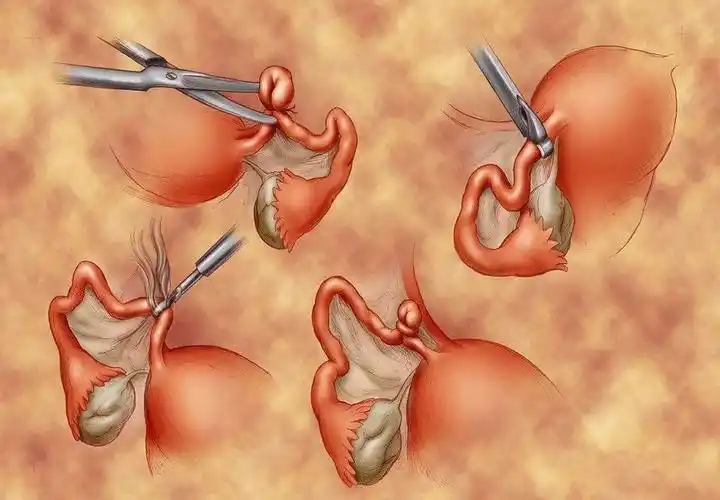 女性要不要做结扎答案很现实网友为什么不让男方去结扎