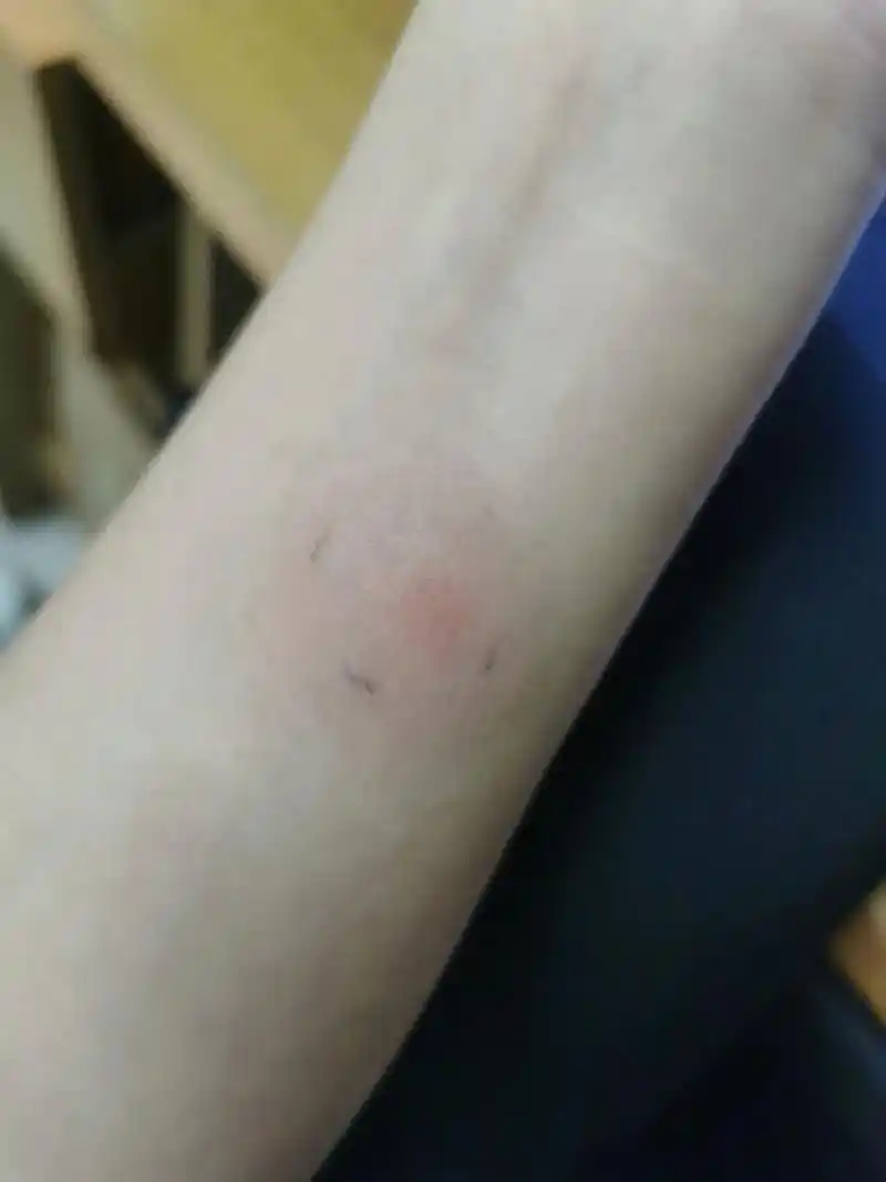 ppd皮试第四天(72小时)1.9*1.