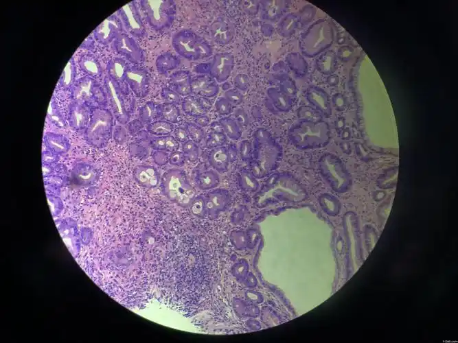 胃镜活检 巨细胞病毒?讨论病例【91360浙江病理沙龙】