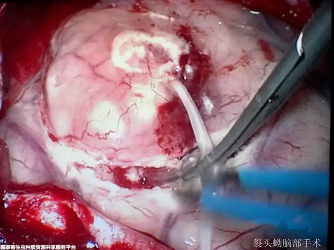 警惕可致神经系统损害和精神障碍的寄生虫病