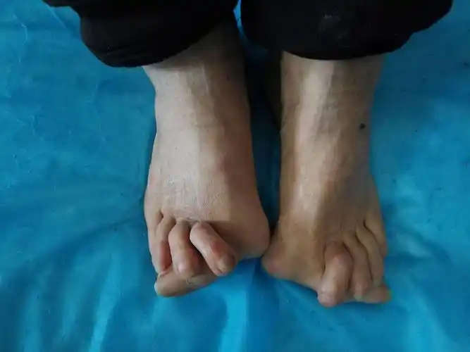 重度类风湿足畸形合并踇外翻矫形1例在我科成功实施手术,术后患者恢复