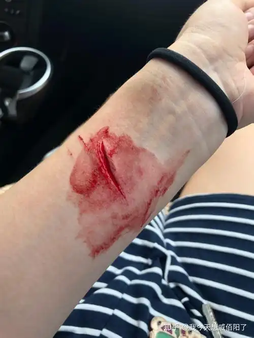 刀口流血照片