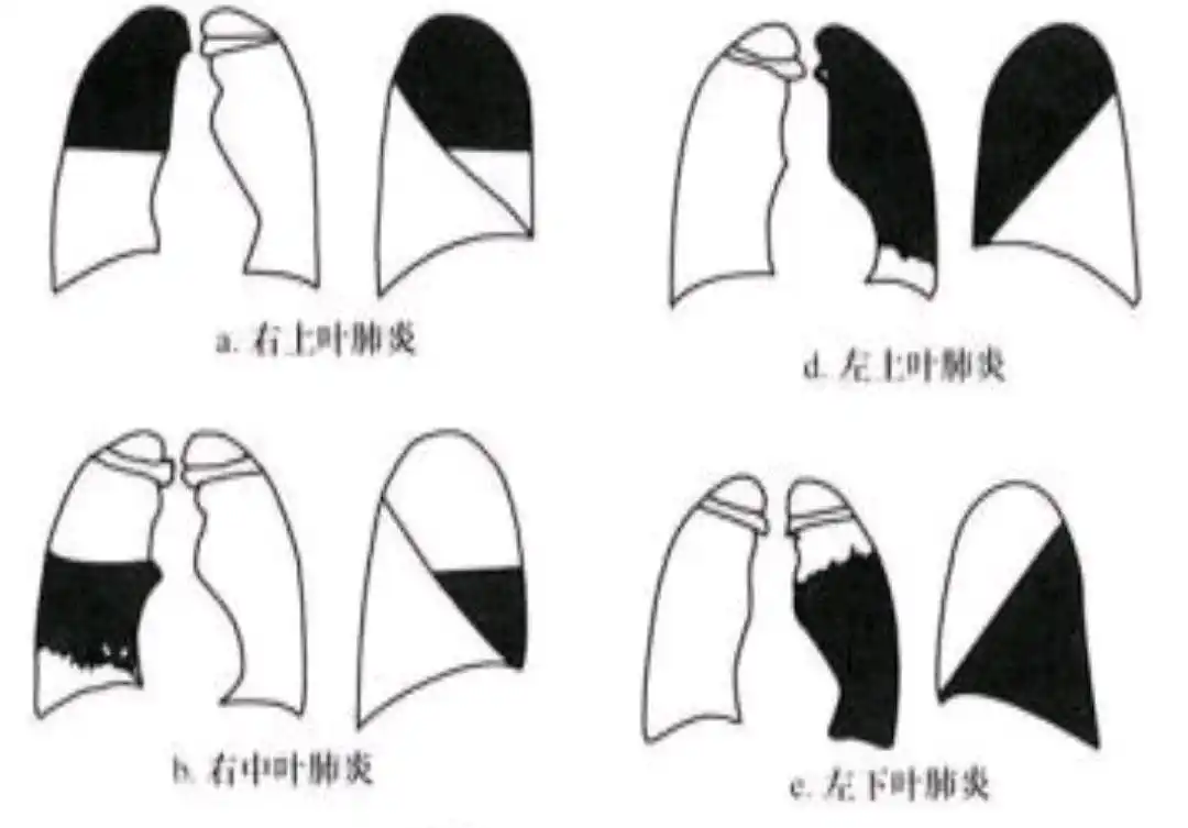 一字之差:大叶性肺炎和小叶性肺炎的区别