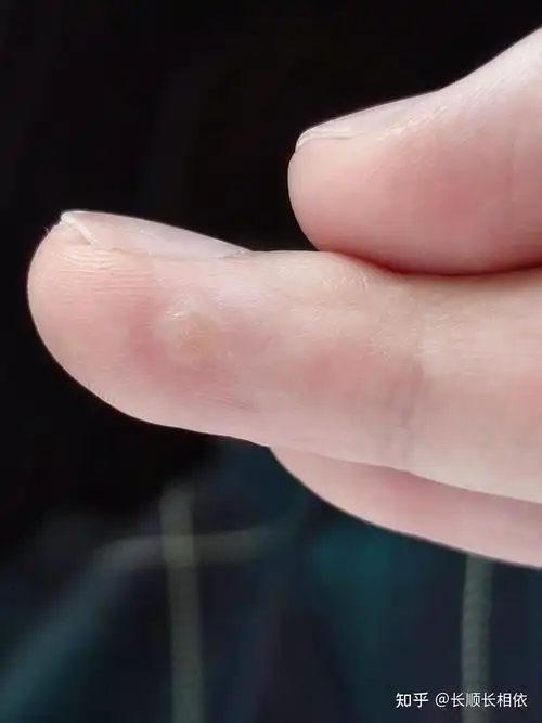 激光去除手指病毒疣记录 复发 - 知乎