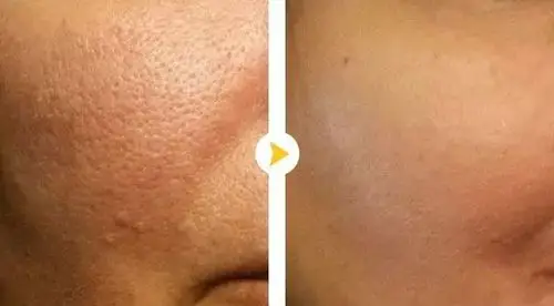 如果摆脱"橘子皮"脸蛋?