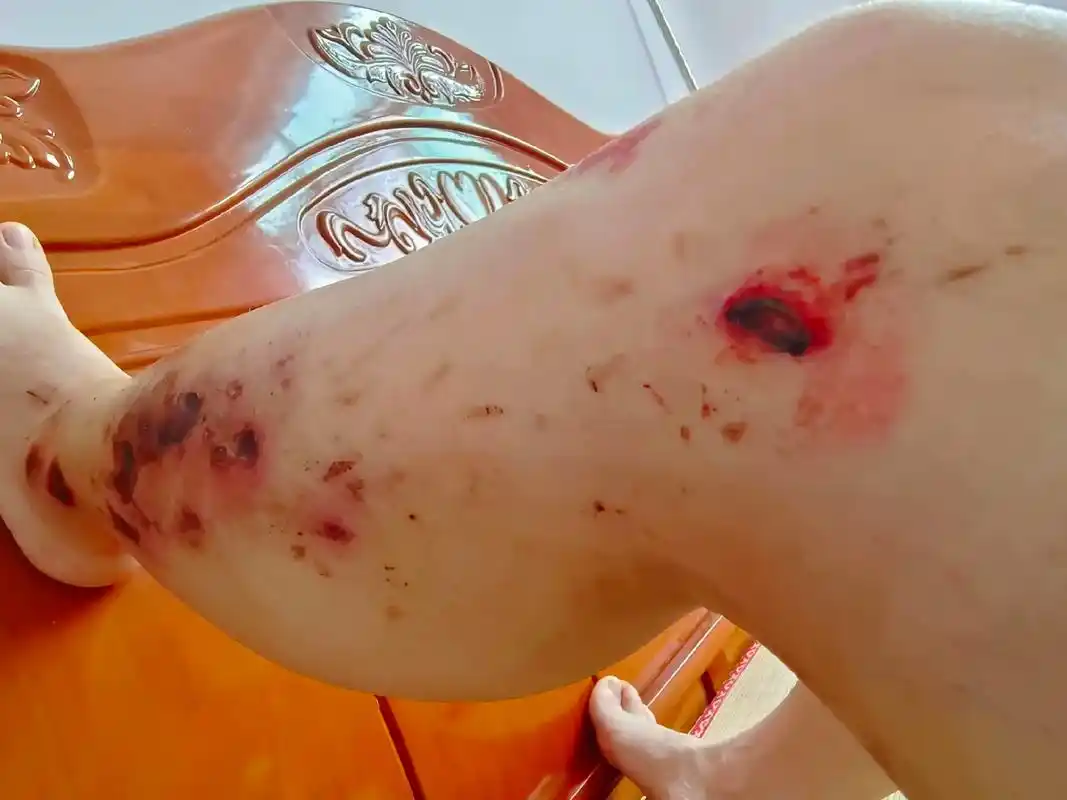 痛过来了,却受不了伤口结痂时的痛痒,伤口形成以后,最难熬的是 - 抖音