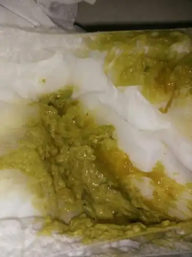 推荐回答 宝宝发热,多见于炎症感染的,大便看含粘液,泡沫,多