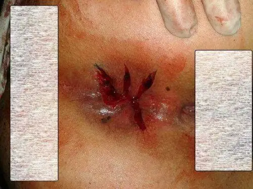 晚上突然感觉肛门口好痒,我一惊.心想是不是痔疮复发了?