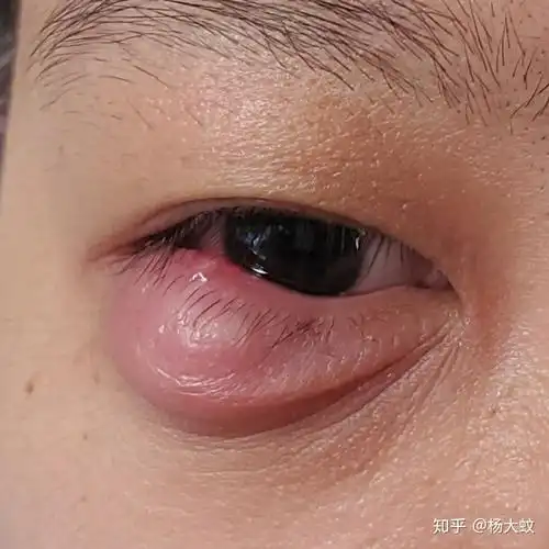 麦粒肿 - 知乎