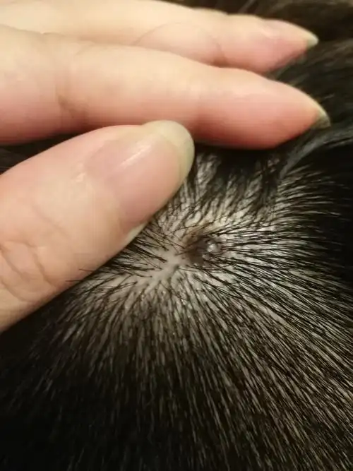 头上长出来的黑痣,挺多年的,从小就有