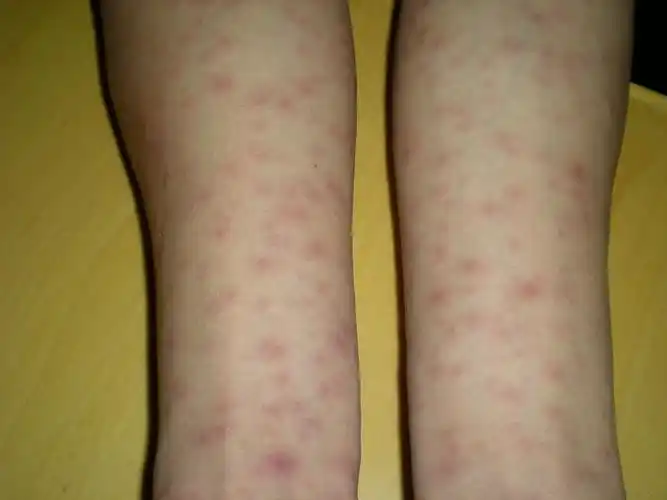 梅毒图片_梅毒症状表现图片大全_有来医生