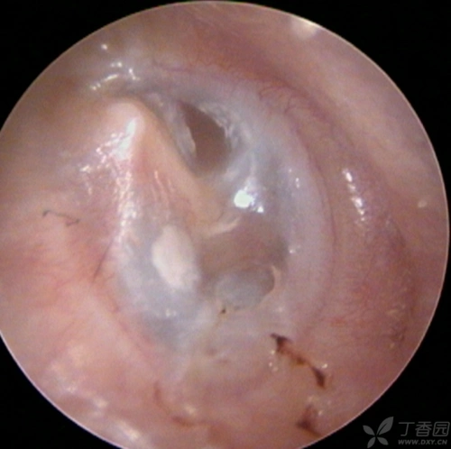 【原创】部分鼓膜膨胀不全的处理 [病例帖]