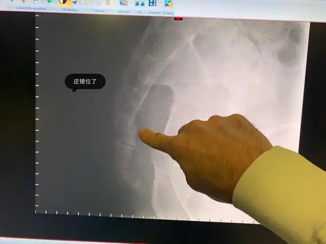 多伦多单板滑雪尾椎摔断经历分享08