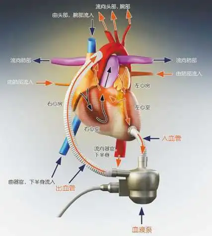 "永仁心"人工心脏,是采用离心泵结构的植入式左心室辅助系统,由体内
