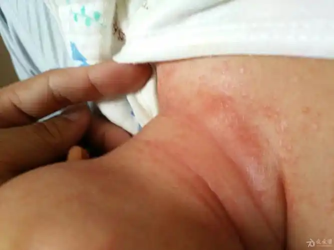 有奖猜图积分大派送八十六间擦疹