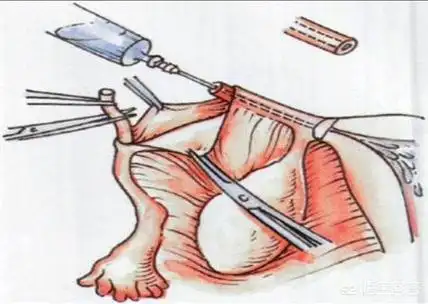 输卵管切除对身体有哪些影响?