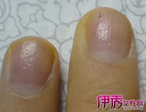 【从指甲看疾病的图片】【图】从指甲看疾病的图片介绍 4种症状清楚