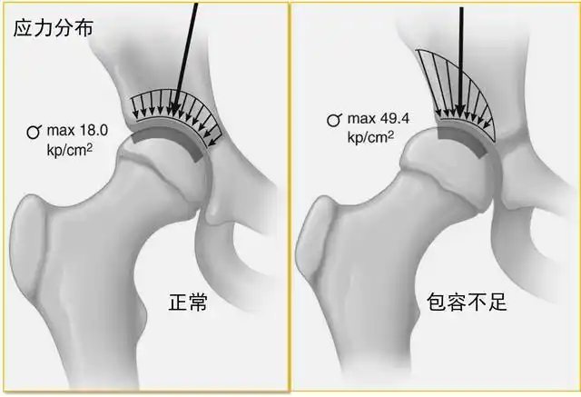 髋关节发育不良为什么会加速软骨磨损?_相关疾病_介绍 - 好大夫在线
