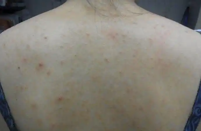 我的背上长了很多痘痘,这是怎么回事