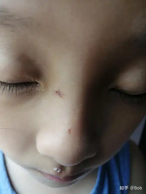 记录一下小朋友手术切痣恢复过程,希望能完全干净! - 知乎