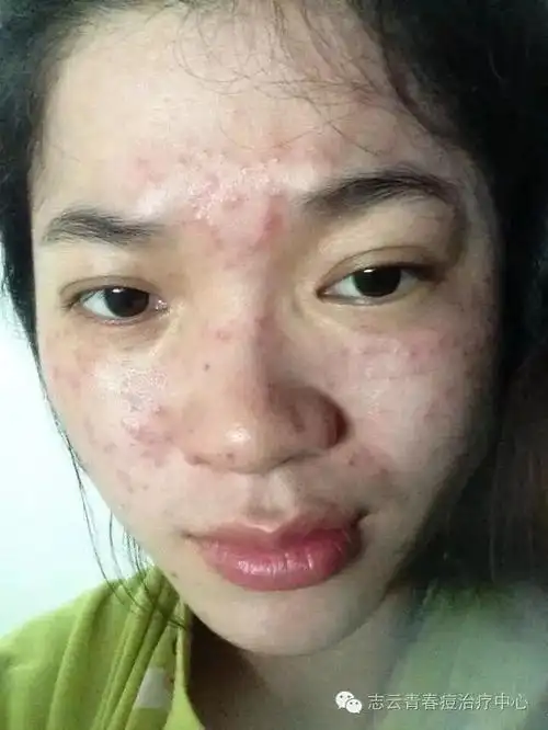 女孩子姨妈前脸上长痘痘的原因?