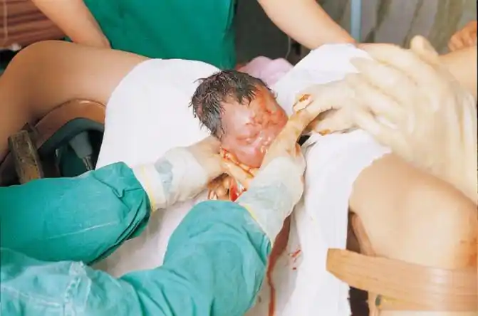 这时要用剪刀剪开会阴,方便孩子娩出.头出来了