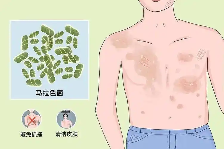 夏日"汗斑"高发,防治汗斑不可少!_马拉_物品_皮肤